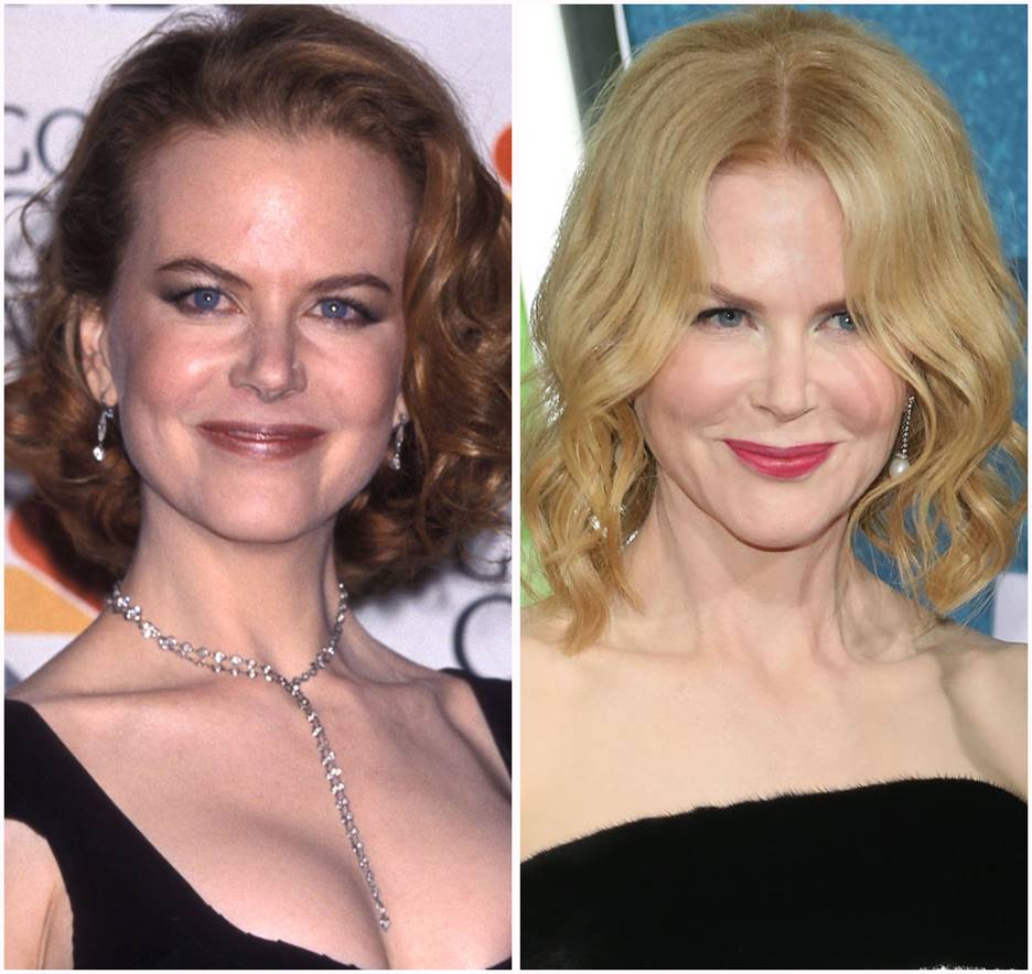 Nicole Kidman Before and After